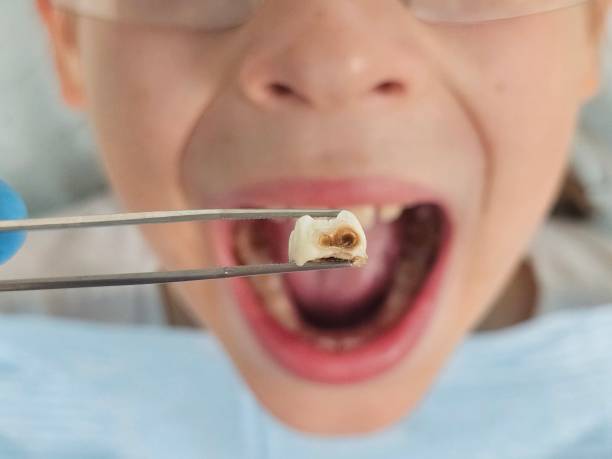 Best Emergency Broken Tooth Repair in Comanche, TX
